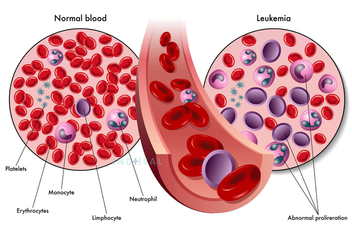 Fighting Blood Cancer: Understanding the Disease and Its Treatment